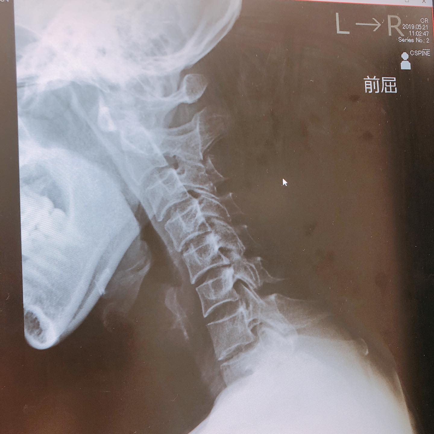 #一昨年くらい#首が曲がらない 左へ首を回そうとすると痛みが出て曲がらなくなっていました。焦って病院でレントゲン。まだ大丈夫ですよと、安心したものの進行したらどうしようと不安で当時は隣人の嫌がらせを受けていて半年くらいも続いて警察に相談に行っていた頃。夜眠れないストレスもあったんだろうなあ、と思います。左足、左足肘関節、からの首の左向き引越ししてすぐ緊急事態宣言で帯状疱疹が出て免疫疾患の私が免疫下がってしまってコロナになったら死んじゃうんじゃないかって不安で不安で。#それが去年緊急事態宣言解除されてジムに通い#有酸素運動 で身体を温めてからたっぷりストレッチしてそしたら左へ首がだいぶ回るように。ストレッチを怠ると首や全身バキバキになるので笑顔で生きるためにストレッチは必須。身体を動かす運動するって生きることに直結してるだから病気になってウォーキングが本当大切だってことがどんどん身に染みてくる。首が回らなくなる未来は嫌だから今の選択を変える今は断薬してても体調が安定してます。#笑顔の未来毎日コツコツ。積み重ねていこ。#リウマチ #シェーグレン#膠原病#シングルマザー#2兄弟 まだまだママは元気で2人と一緒に笑って暮らしていたい️ (Instagram)